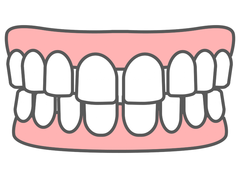 空隙歯列(すきっ歯)を直したい