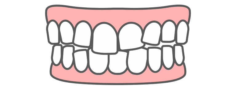 叢生(八重歯)を直したい