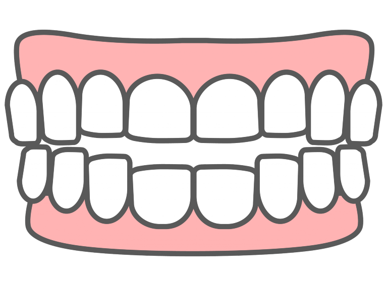 開咬を直したい